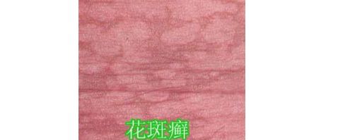 汗斑癣的表现症状有哪些?