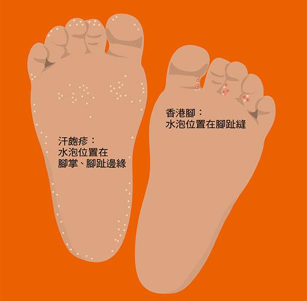 汗疱疹就是香港脚吗？
